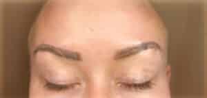 Botox
