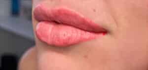 Lip Filler