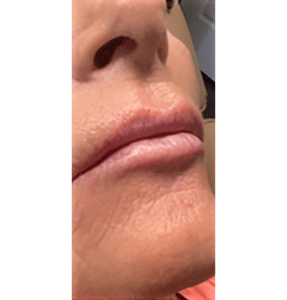 Lip Filler