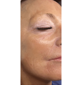 Microneedling, PRP, Retinol
