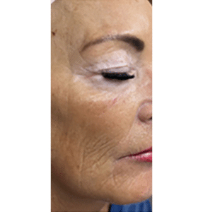 Microneedling, PRP, Retinol