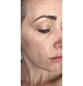 Microneedling, ZO Skin Care