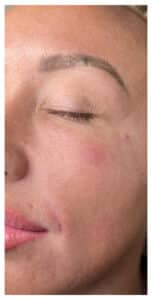 Microneedling, PRP, ZO Skin Care
