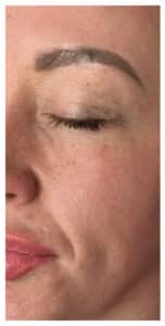 Microneedling, PRP, ZO Skin Care