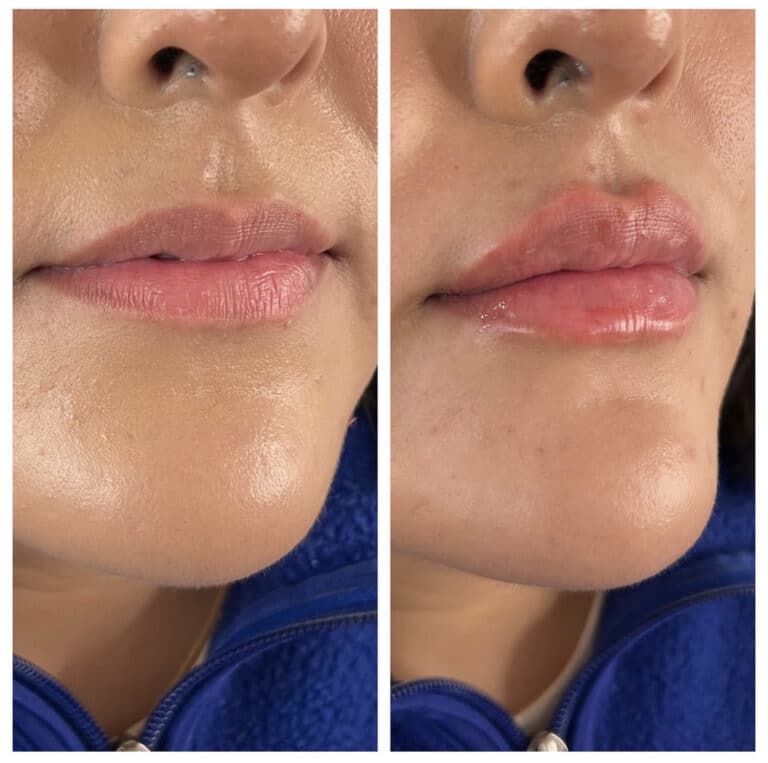 Plump lips after a lip filler treatment by Nurse Katrina at Third Eye Beauty Lounge in Tempe, AZ.
