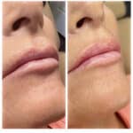 before and after lip fillers by katrina at third eye beauty lounge in tempe az