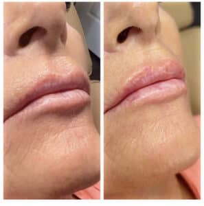 before and after lip fillers by katrina at third eye beauty lounge in tempe az