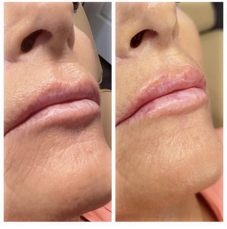 before and after lip fillers by katrina at third eye beauty lounge in tempe az