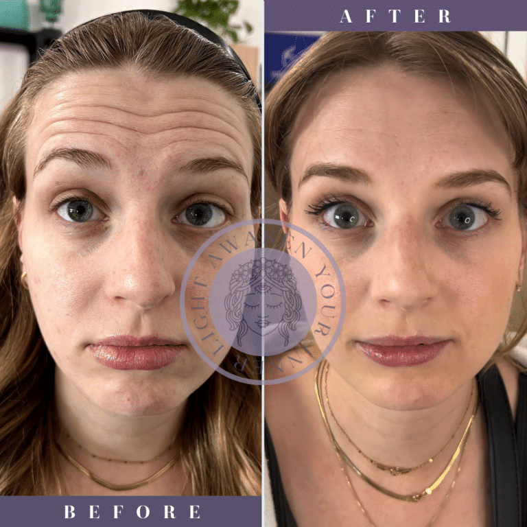 getting botox this holiday season? make sure to get it 2 weeks prior to your event