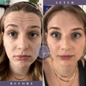 Botox Before & After By Katrina at Third Eye Beauty Lounge in Tempe AZ