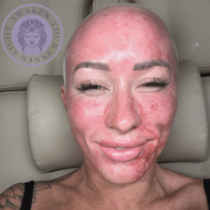 Vampire Facial by Katrina at Third Eye Beauty Lounge in Tempe AZ