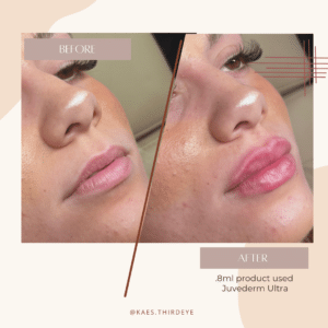 tempe arizona lip filler with juvederm
