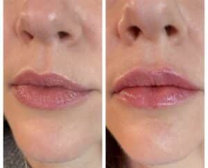 Lip Injections by Katrina at Third Eye Beauty Lounge in Tempe AZ
