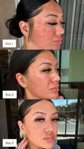 Real Results From Microneedling by Third Eye Beauty Lounge in Tempe AZ