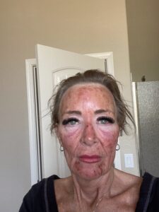 Post Microneedling Third Eye Beauty Lounge in Tempe AZ
