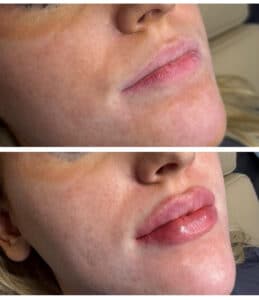 Close-up of soft, natural-looking lips enhanced with Restylane Kysse lip filler at Third Eye Beauty Lounge in Tempe, AZ.
