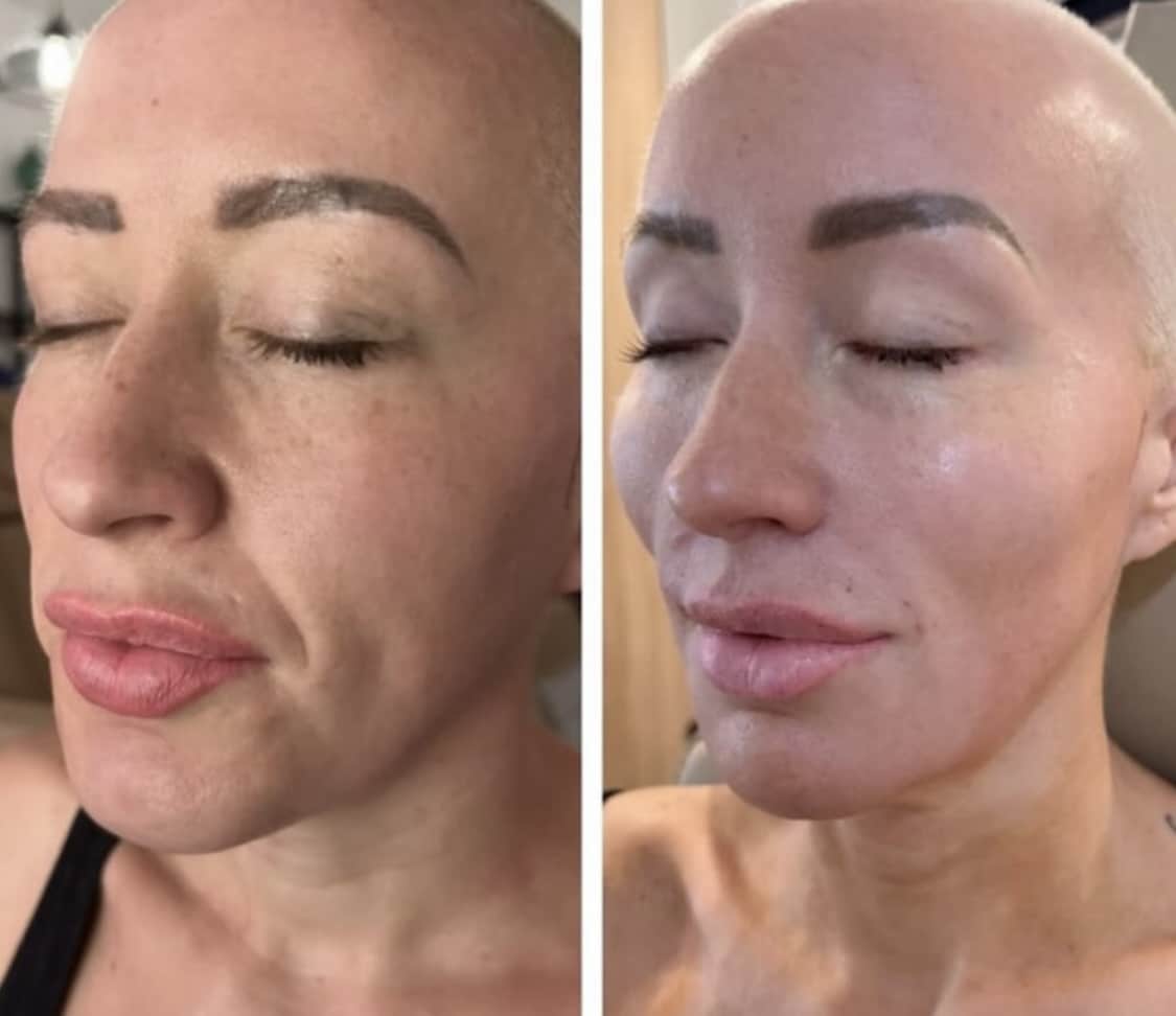 Side-by-side before and after photo showing facial filler results for nasolabial folds and overall skin rejuvenation at Third Eye Beauty Lounge in Tempe, AZ.