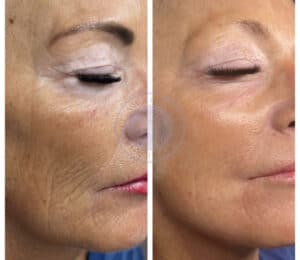 Before and after microneedling results at Third Eye Beauty Lounge in Tempe, Arizona, showing smoother texture, smaller pores, and a healthy post-treatment glow.