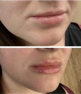Natural Revanesse lip filler before and after by Nurse Katrina at Third Eye Beauty Lounge in Tempe, Arizona.